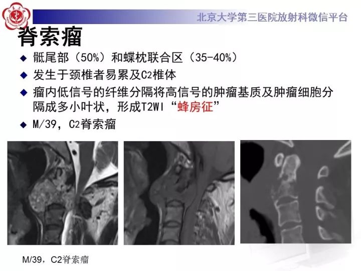【病例】颈椎血管瘤1例CT及MR