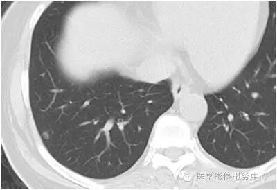 【病例】肺内小结节,估计80%的同行都没考虑这个诊断 【病例】肺内小结节,估计80%的同行都没考虑这个诊断