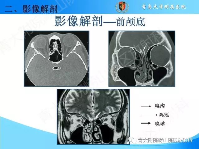 【PPT】颅底孔道的影像解剖和诊断
