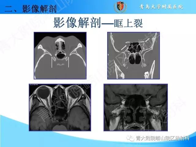 【PPT】颅底孔道的影像解剖和诊断