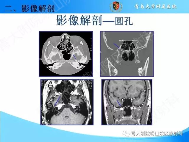 【PPT】颅底孔道的影像解剖和诊断