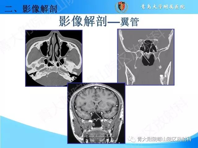 【PPT】颅底孔道的影像解剖和诊断