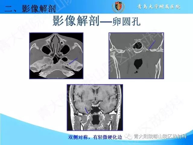 【PPT】颅底孔道的影像解剖和诊断