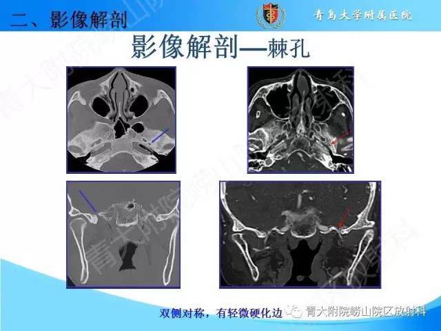 【PPT】颅底孔道的影像解剖和诊断