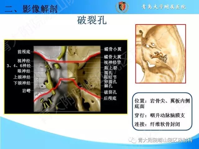 【PPT】颅底孔道的影像解剖和诊断