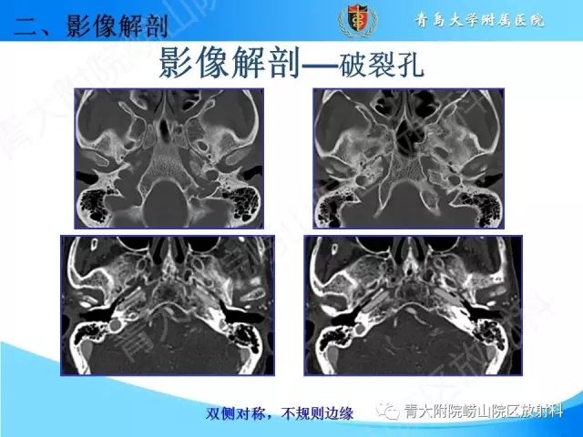 【PPT】颅底孔道的影像解剖和诊断