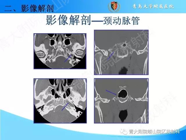 【PPT】颅底孔道的影像解剖和诊断