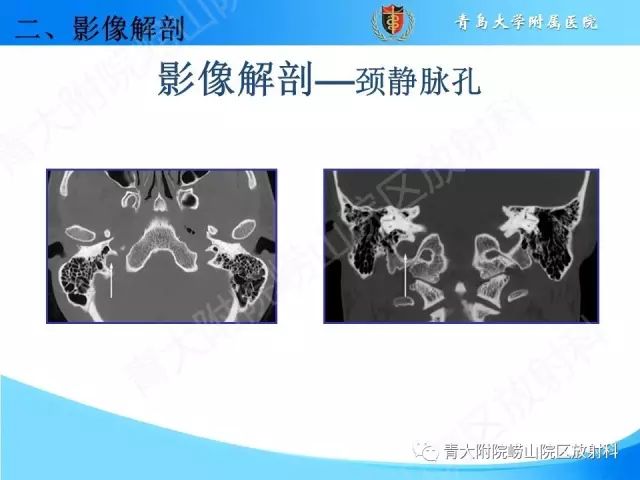【PPT】颅底孔道的影像解剖和诊断