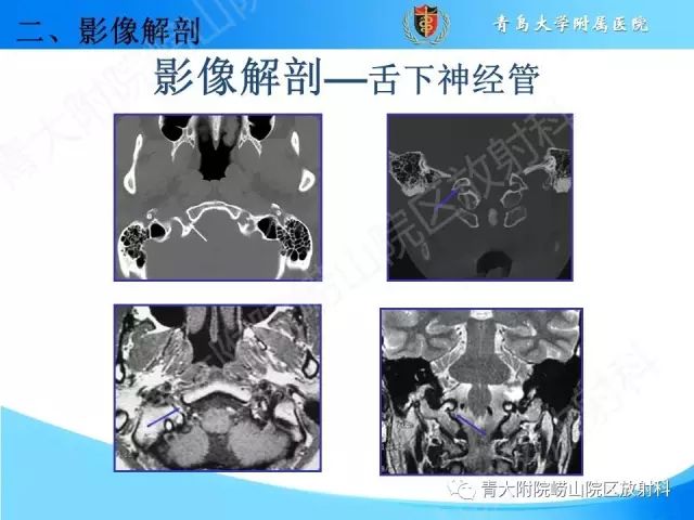 【PPT】颅底孔道的影像解剖和诊断