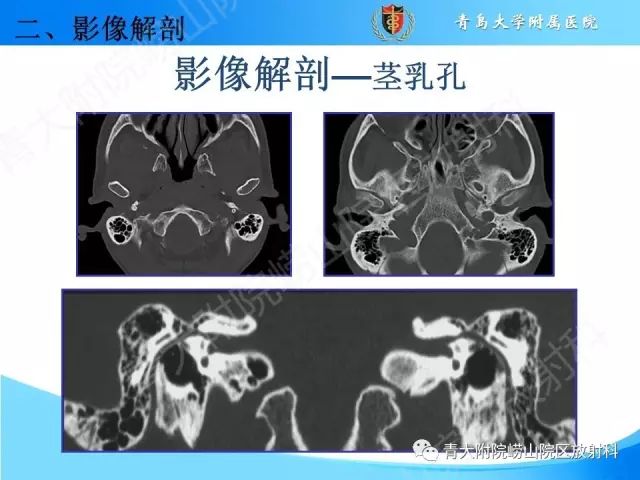 【PPT】颅底孔道的影像解剖和诊断