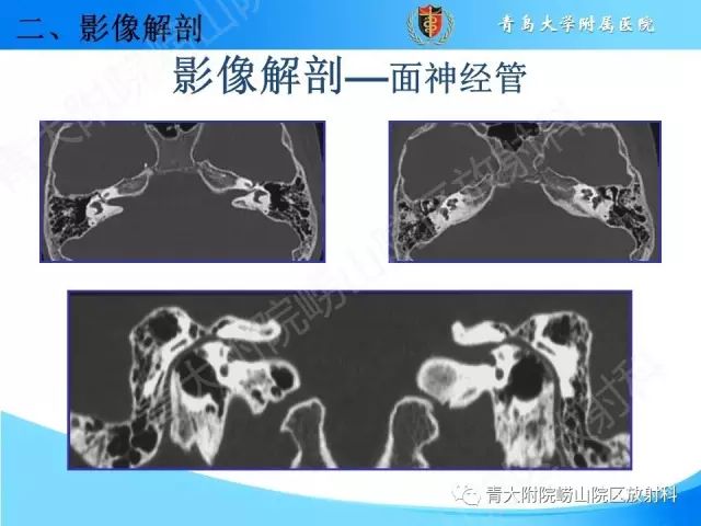 【PPT】颅底孔道的影像解剖和诊断