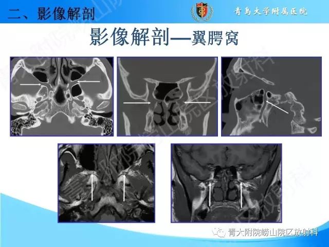 【PPT】颅底孔道的影像解剖和诊断