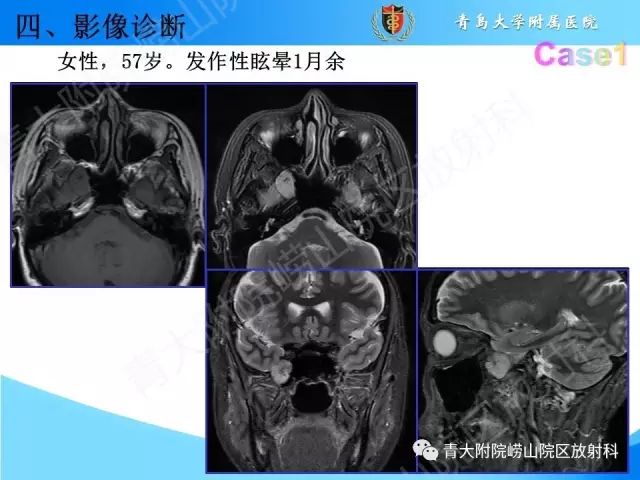 【PPT】颅底孔道的影像解剖和诊断