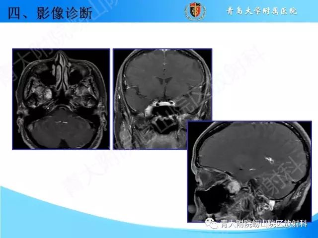 【PPT】颅底孔道的影像解剖和诊断