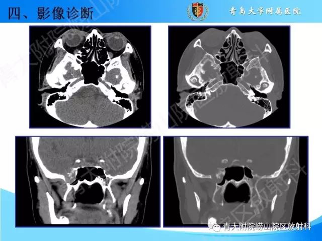 【PPT】颅底孔道的影像解剖和诊断