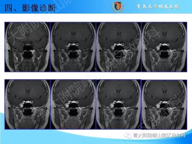 【PPT】颅底孔道的影像解剖和诊断