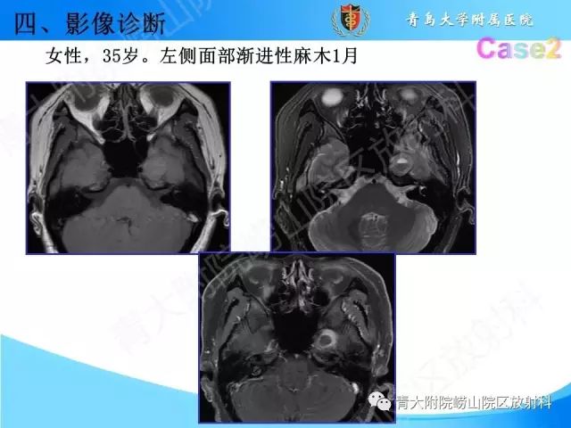 【PPT】颅底孔道的影像解剖和诊断