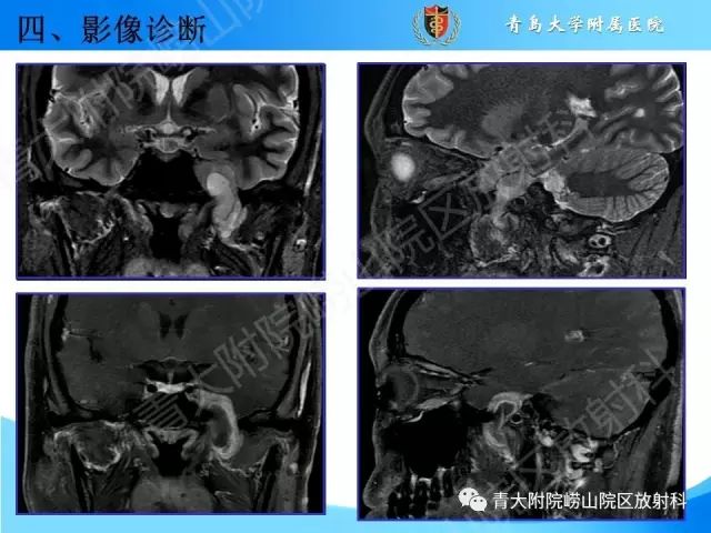 【PPT】颅底孔道的影像解剖和诊断