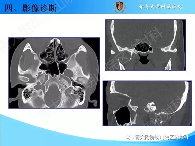 【PPT】颅底孔道的影像解剖和诊断