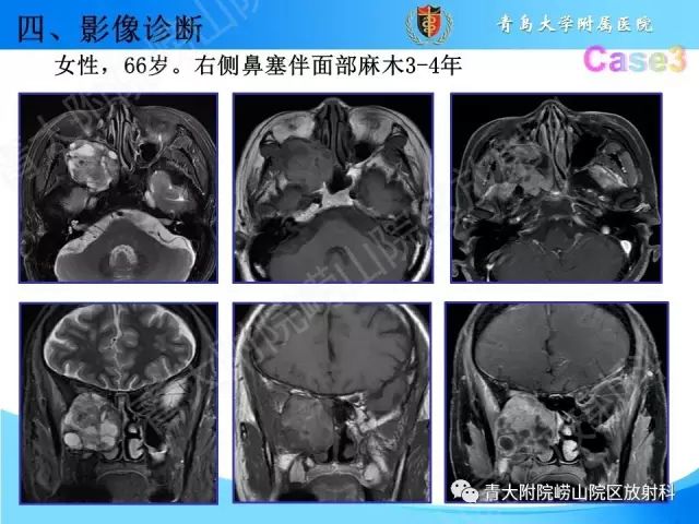 【PPT】颅底孔道的影像解剖和诊断