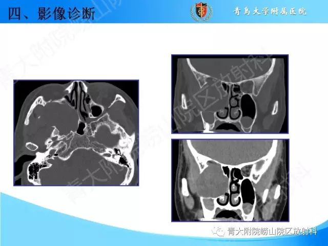 【PPT】颅底孔道的影像解剖和诊断