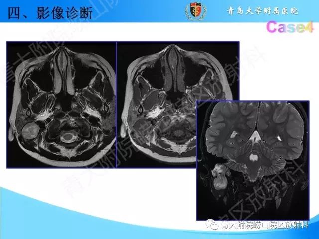 【PPT】颅底孔道的影像解剖和诊断