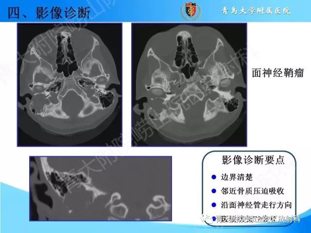 【PPT】颅底孔道的影像解剖和诊断