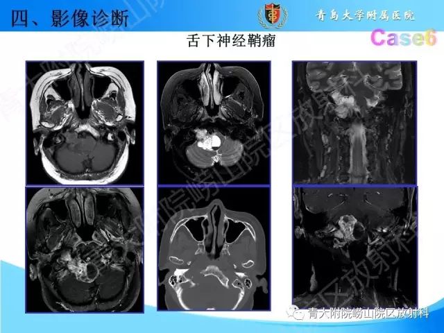 【PPT】颅底孔道的影像解剖和诊断