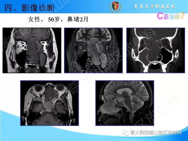 【PPT】颅底孔道的影像解剖和诊断