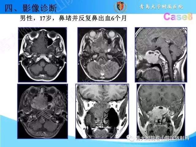 【PPT】颅底孔道的影像解剖和诊断