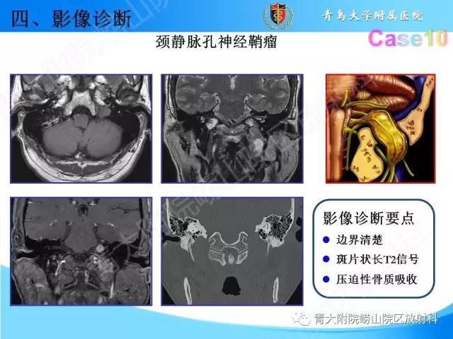 【PPT】颅底孔道的影像解剖和诊断