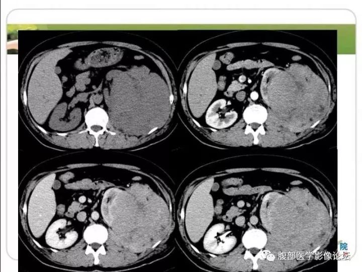 【病例】左肾孤立性浆细胞瘤1例CT