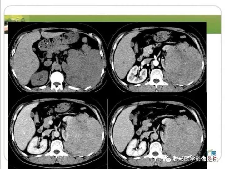 【病例】左肾孤立性浆细胞瘤1例CT