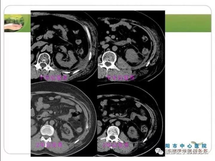 【病例】左肾孤立性浆细胞瘤1例CT