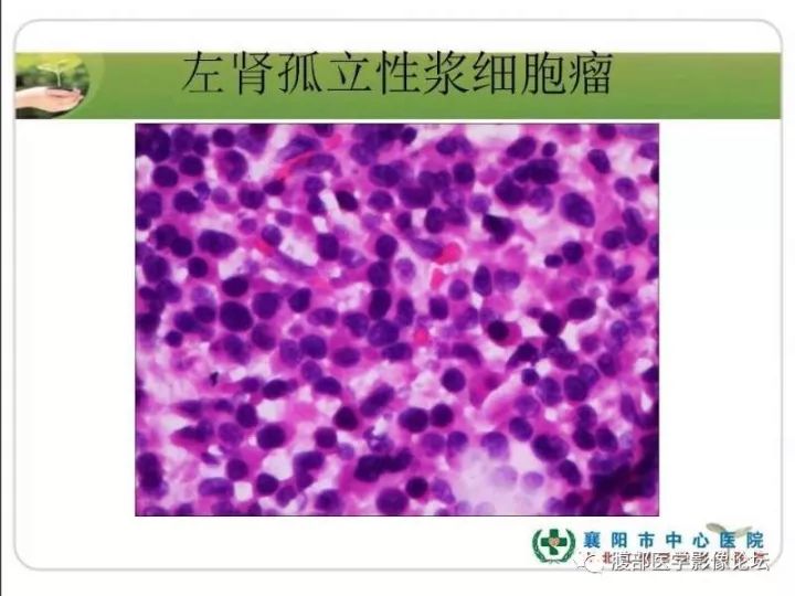 【病例】左肾孤立性浆细胞瘤1例CT