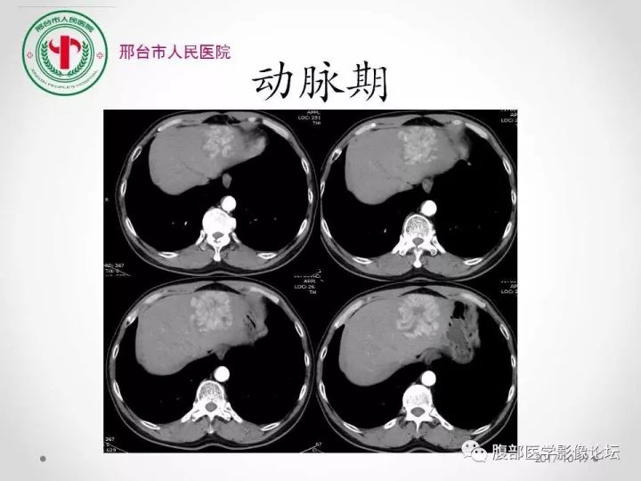 【病例】肝脏原发性神经内分泌肿瘤1例CT影像表现
