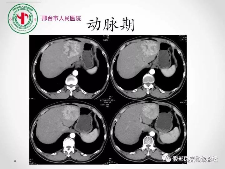 【病例】肝脏原发性神经内分泌肿瘤1例CT影像表现