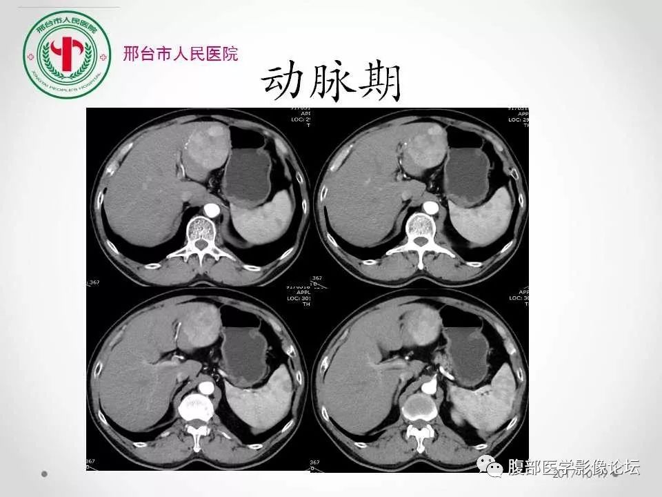 【病例】肝脏原发性神经内分泌肿瘤1例CT影像表现