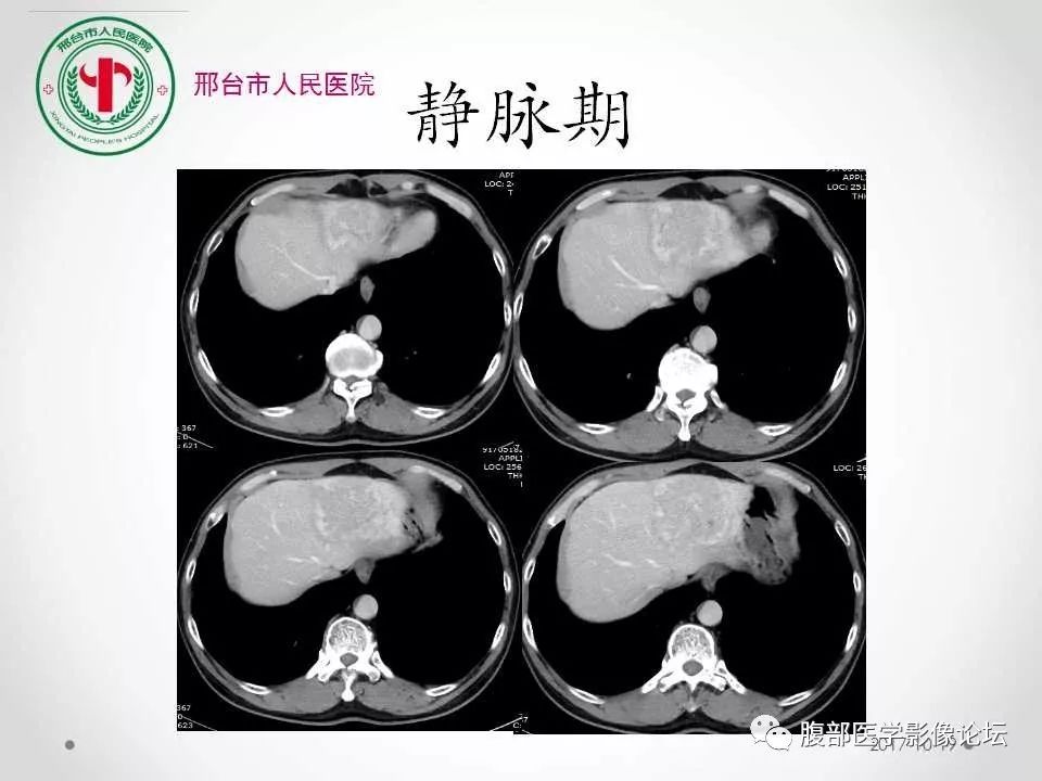 【病例】肝脏原发性神经内分泌肿瘤1例CT影像表现