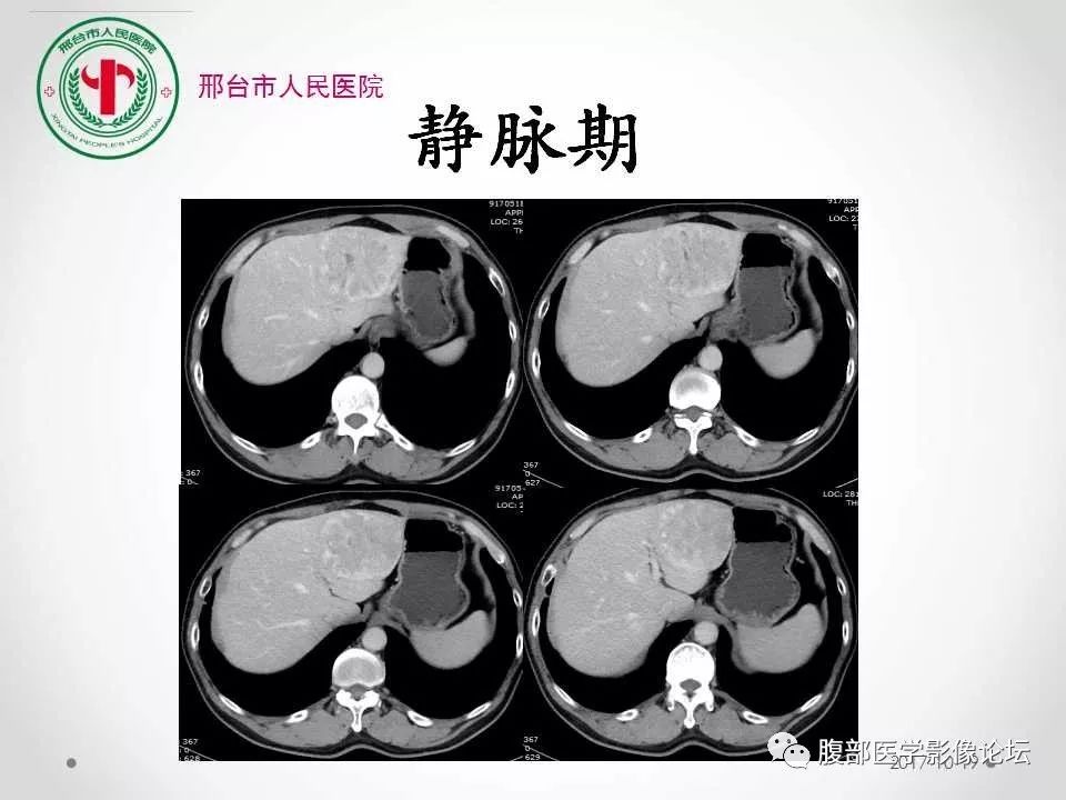 【病例】肝脏原发性神经内分泌肿瘤1例CT影像表现