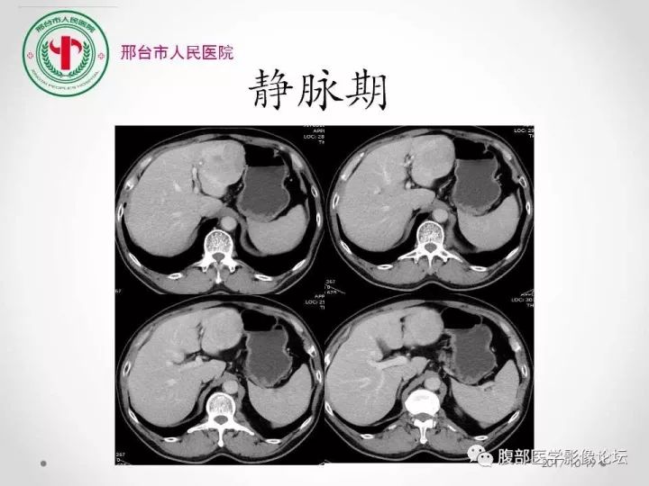【病例】肝脏原发性神经内分泌肿瘤1例CT影像表现