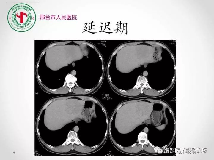 【病例】肝脏原发性神经内分泌肿瘤1例CT影像表现
