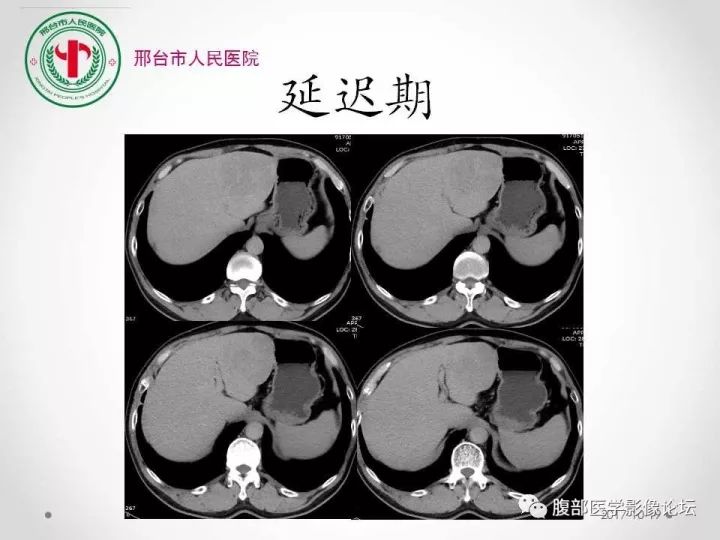 【病例】肝脏原发性神经内分泌肿瘤1例CT影像表现