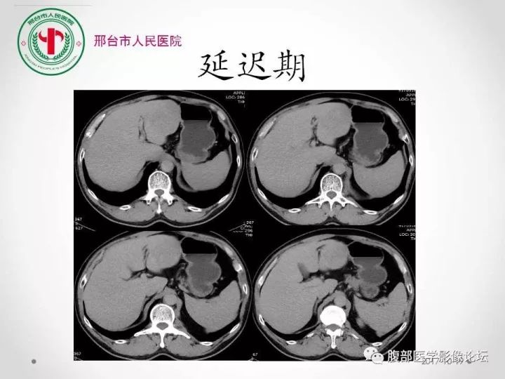 【病例】肝脏原发性神经内分泌肿瘤1例CT影像表现