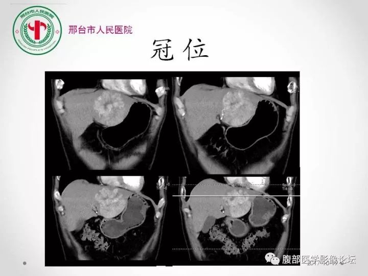 【病例】肝脏原发性神经内分泌肿瘤1例CT影像表现