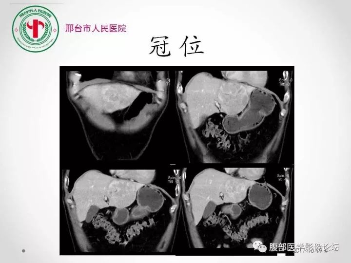 【病例】肝脏原发性神经内分泌肿瘤1例CT影像表现