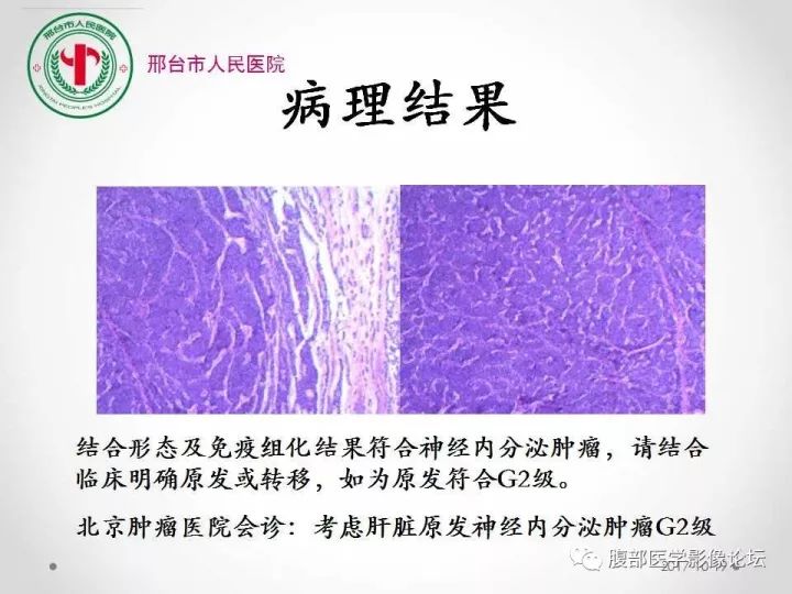 【病例】肝脏原发性神经内分泌肿瘤1例CT影像表现