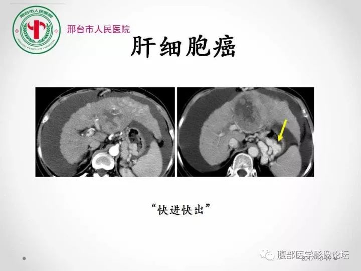 【病例】肝脏原发性神经内分泌肿瘤1例CT影像表现