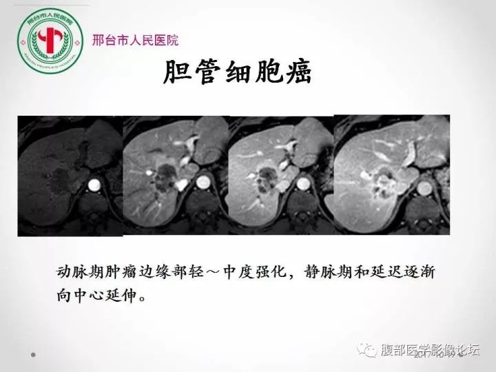 【病例】肝脏原发性神经内分泌肿瘤1例CT影像表现