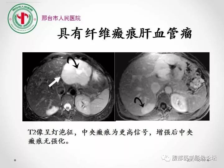 【病例】肝脏原发性神经内分泌肿瘤1例CT影像表现